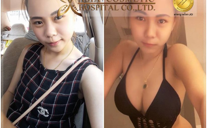 รีวิวเสริมนม