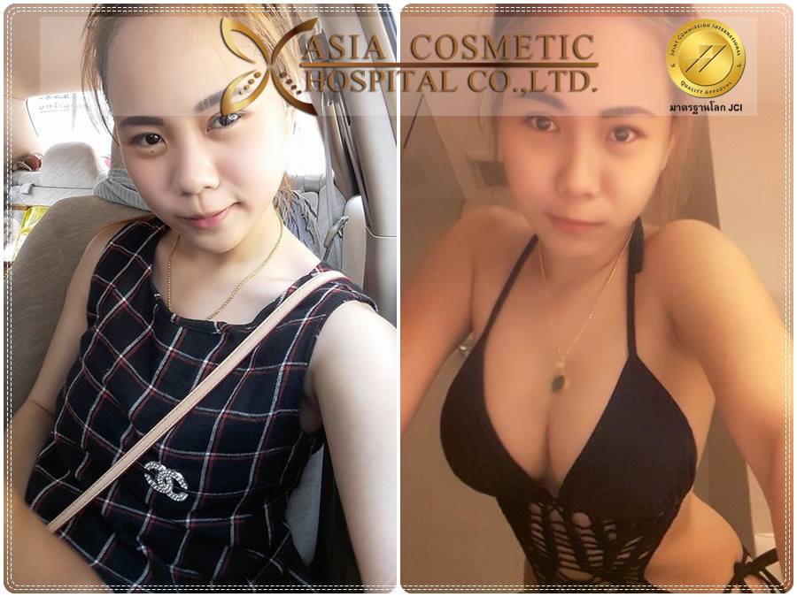 รีวิวเสริมนม