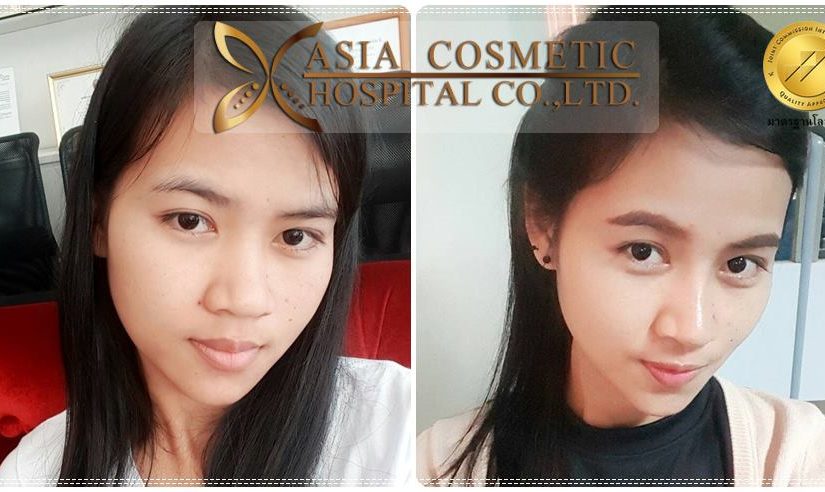 เสริมจมูกที่โรงพยาบาลเอเชียคอสเมติก