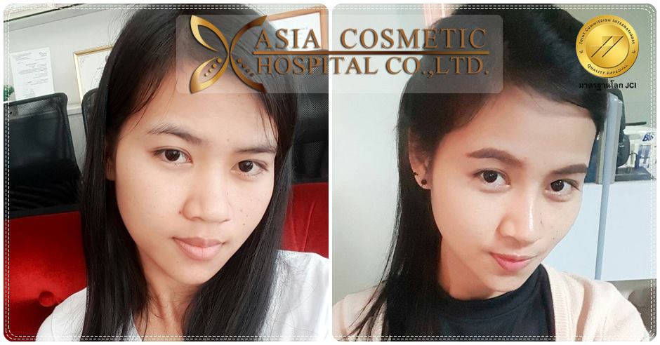 เสริมจมูกที่โรงพยาบาลเอเชียคอสเมติก