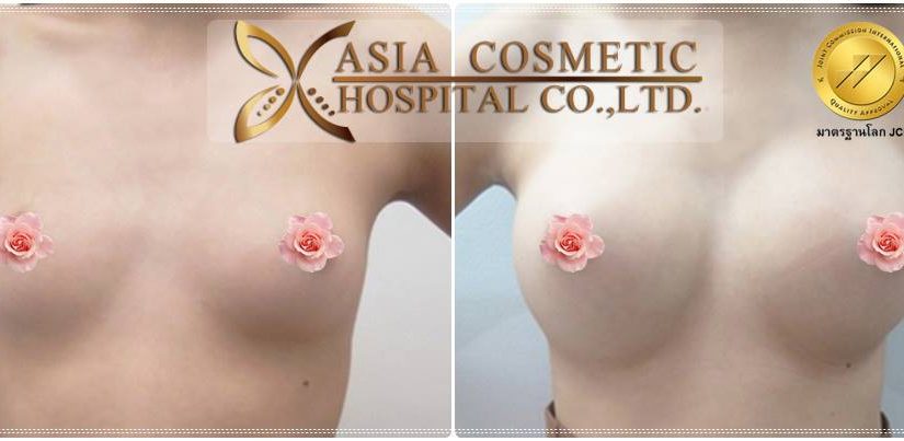 เสริมหน้าอกกับโรงพยาบาลเอเชีย