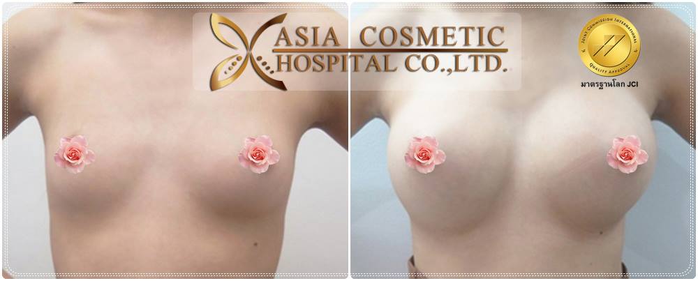เสริมหน้าอกกับโรงพยาบาลเอเชีย