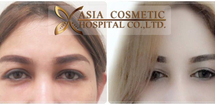 ทำตาสองชั้นแบบกรีด