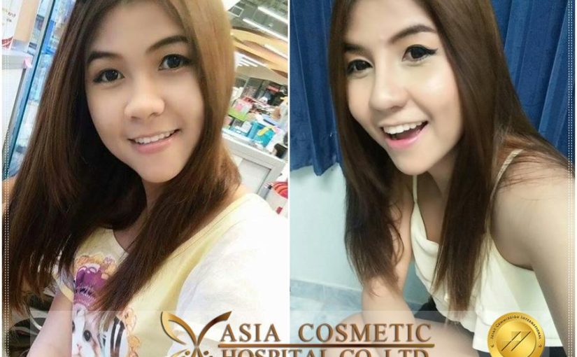 รีวิวเกี่ยวกับศัลยกรรมเสริมจมูก