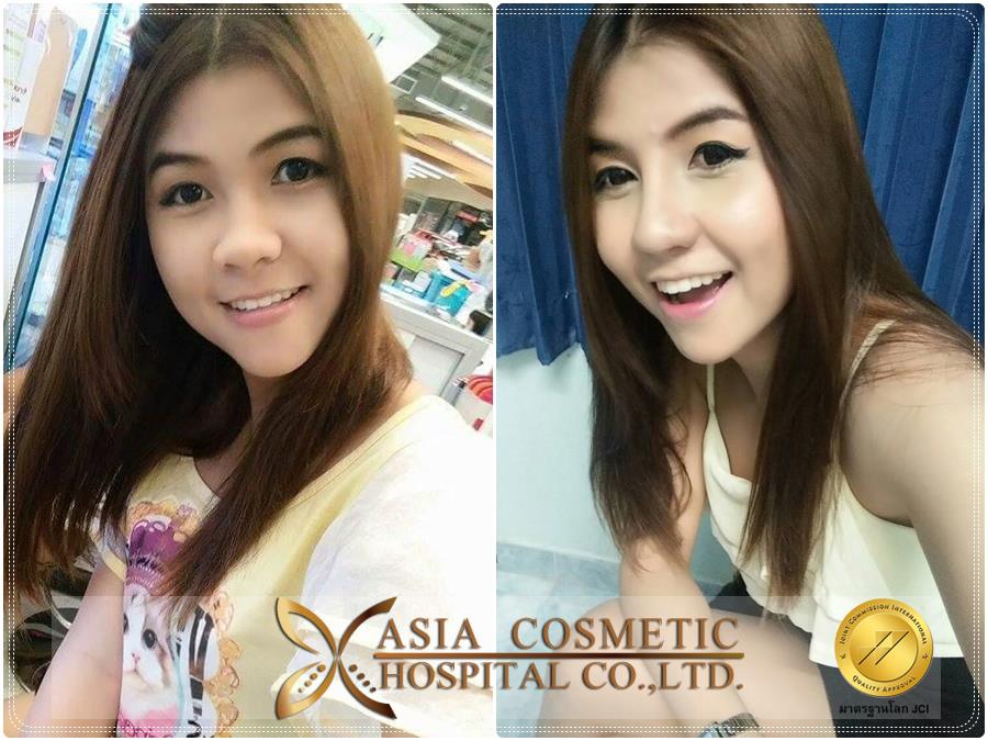 รีวิวเกี่ยวกับศัลยกรรมเสริมจมูก