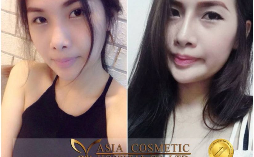 รีวิวเสริมจมูกโรงพยาบาลเอเชียคอสเมติก