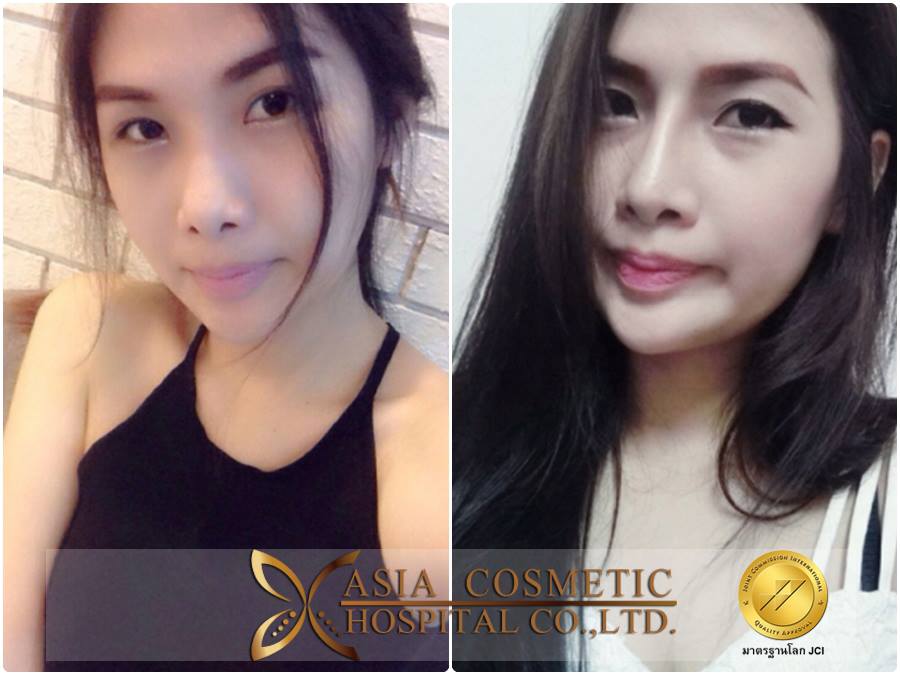 รีวิวเสริมจมูกโรงพยาบาลเอเชียคอสเมติก