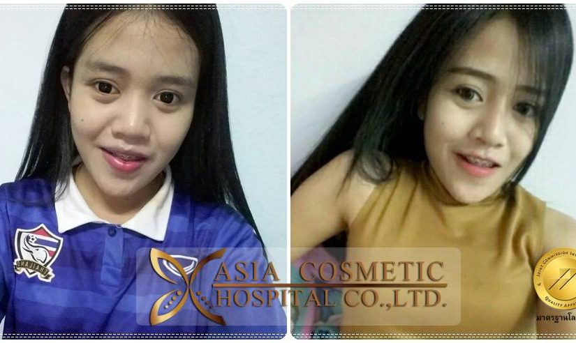 เสริมจมูกที่ไหนดีคะ