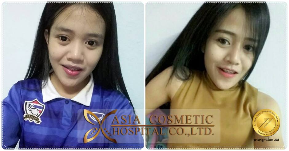 เสริมจมูกที่ไหนดีคะ