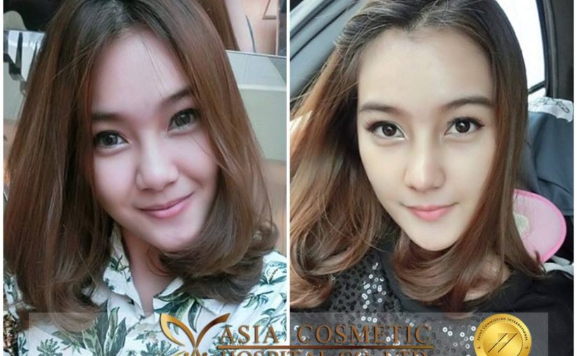 เสริมจมูกที่ไหนสวย