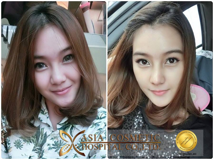 เสริมจมูกที่ไหนสวย