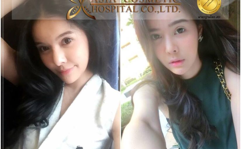 รีวิวเสริมจมูก2017