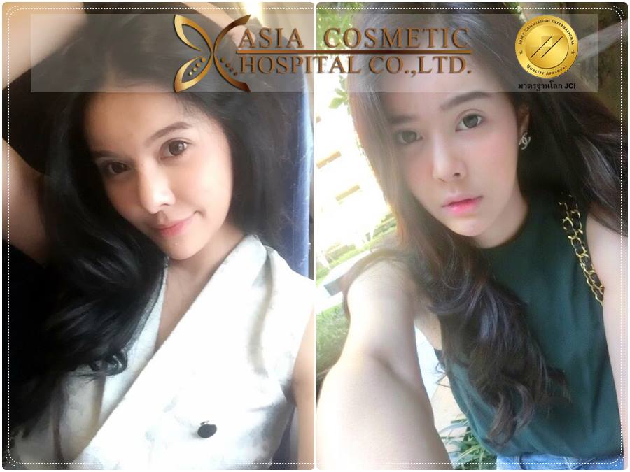 รีวิวเสริมจมูก2017