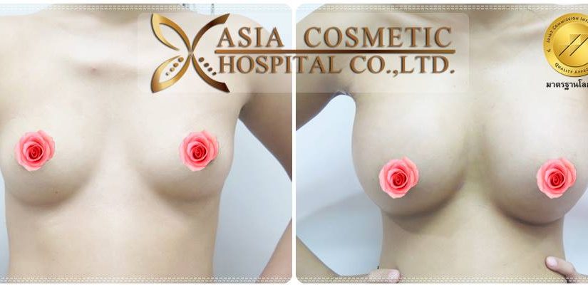 หลังเสริมหน้าอก