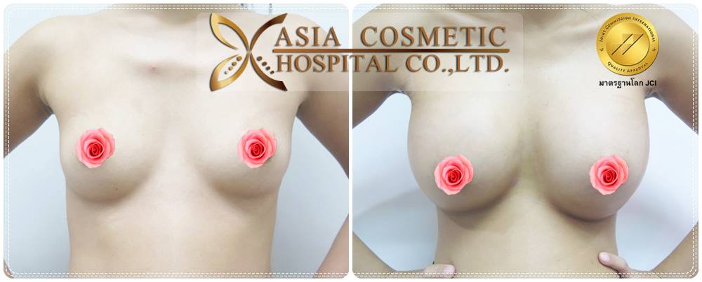 หลังเสริมหน้าอก