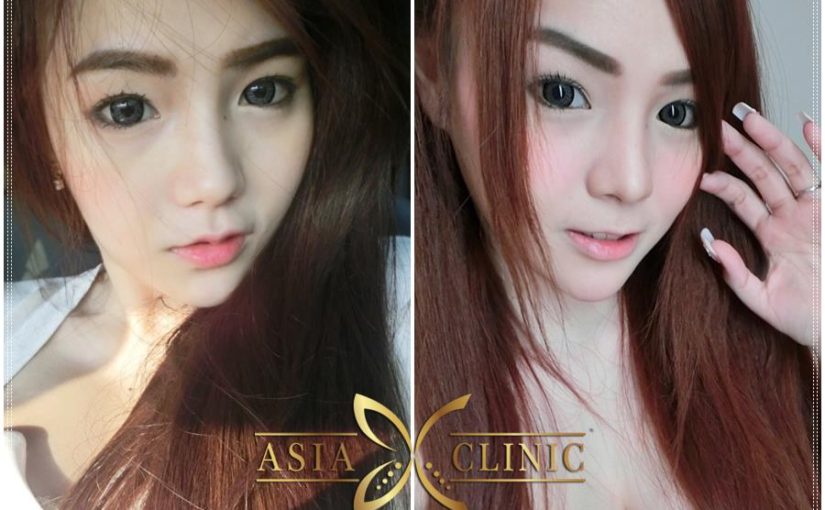 เสริมจมูกสวย