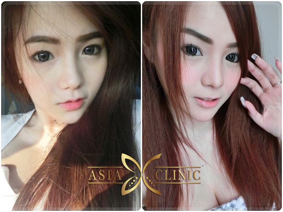 เสริมจมูกสวย