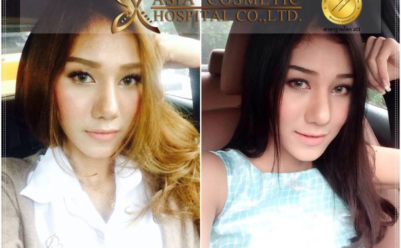 การแก้ไขจมูก