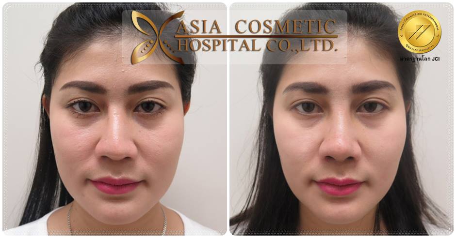 ตัดปีกจมูก