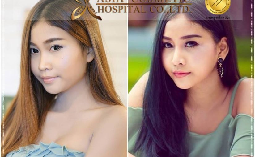 รีวิวการเสริมจมูก