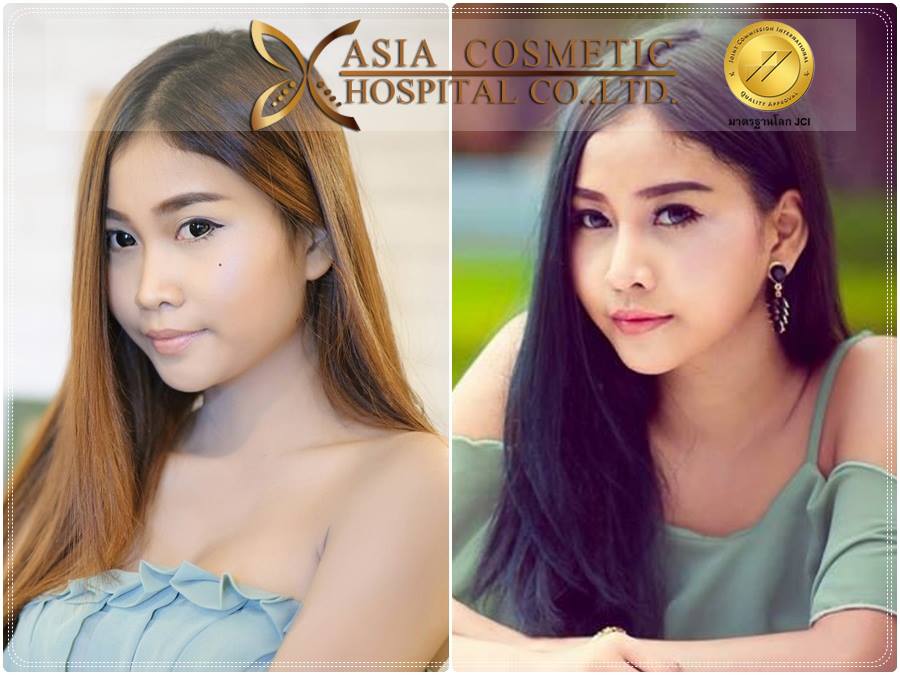 รีวิวการเสริมจมูก