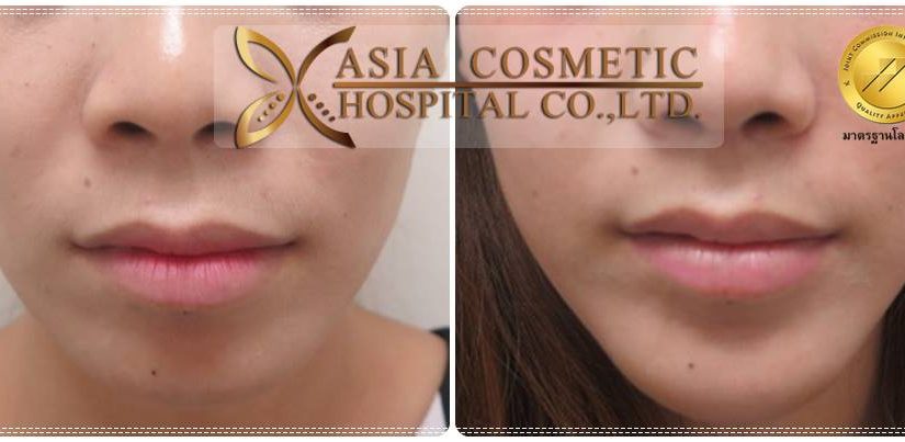 รีวิวคาง