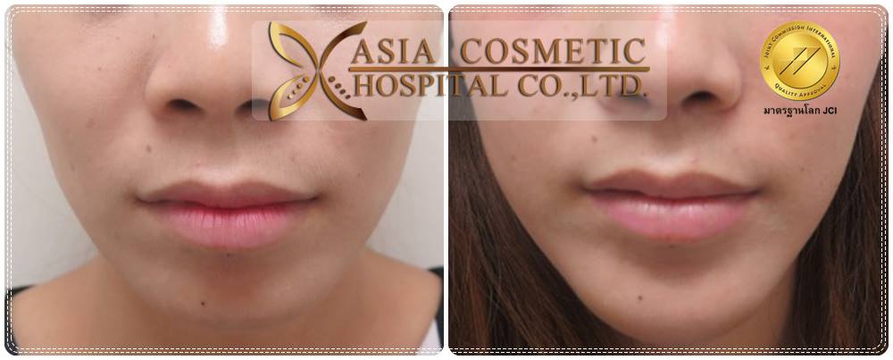 รีวิวคาง