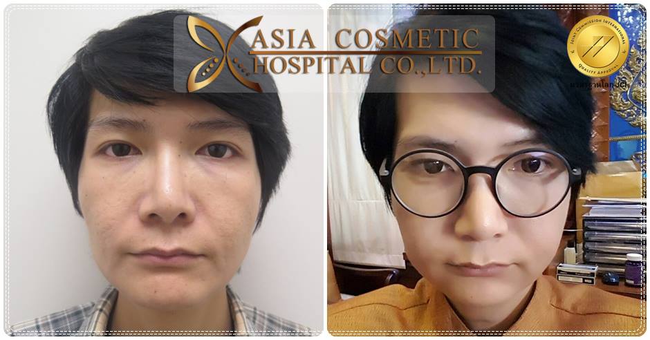 รีวิวตัดกราม