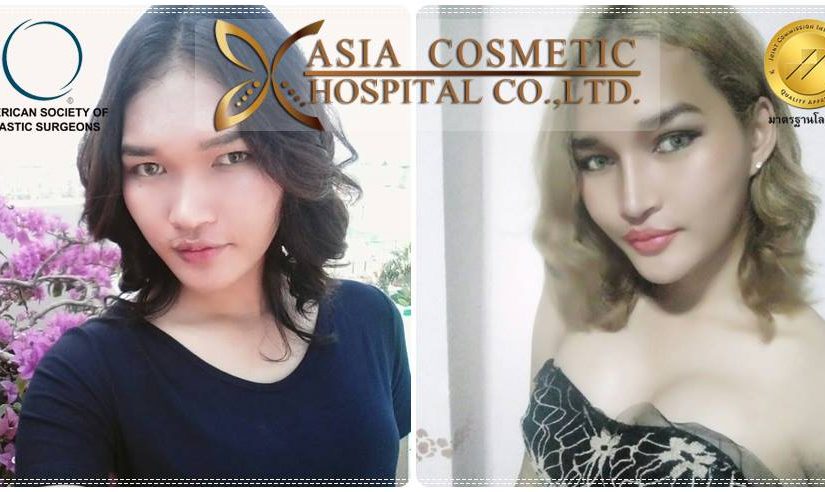 รีวิวเสริมจมูกจากโรงพยาบาลเอเชียคอสเมติก