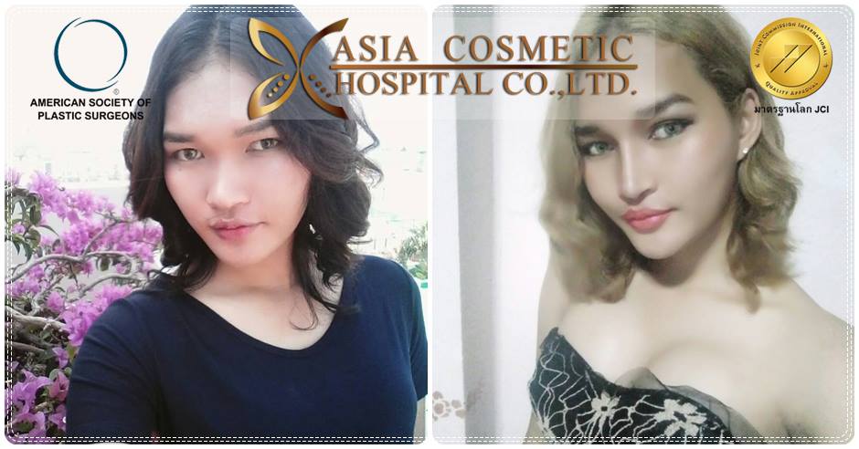 รีวิวเสริมจมูกจากโรงพยาบาลเอเชียคอสเมติก