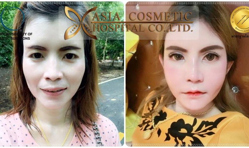 ยุบโหนกแก้ม