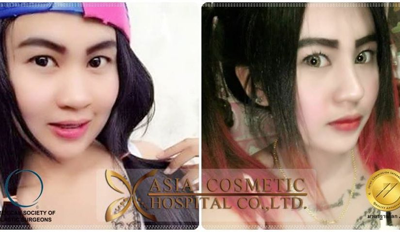 รีวิวเสริมจมูก