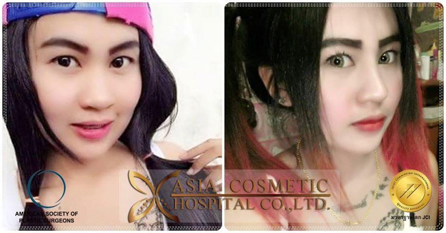 รีวิวเสริมจมูก