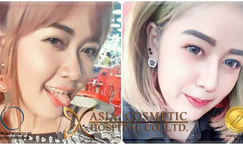 เสริมจมูก