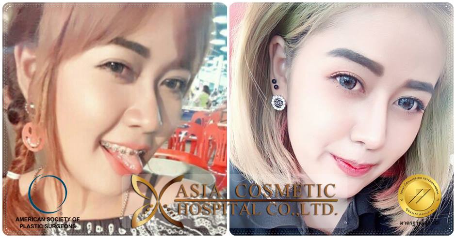 เสริมจมูก