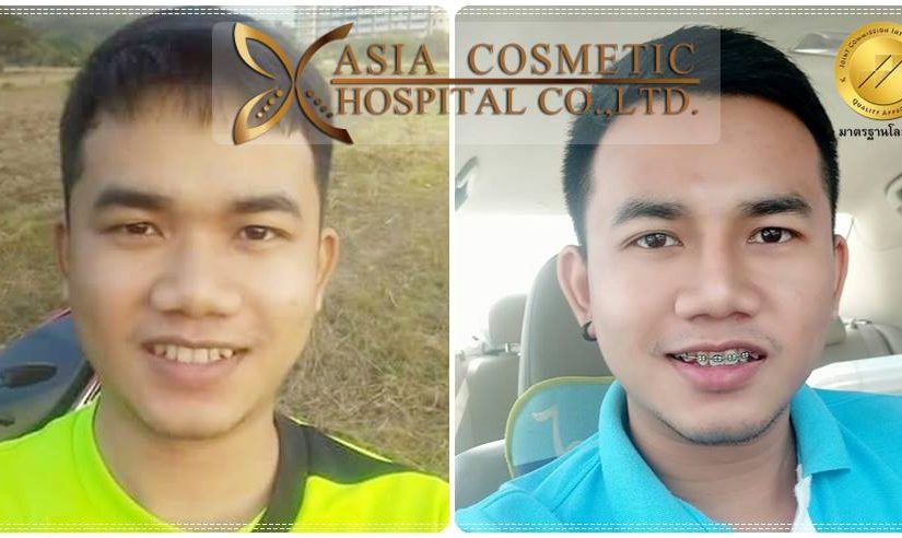 เสริมจมูกผู้ชาย