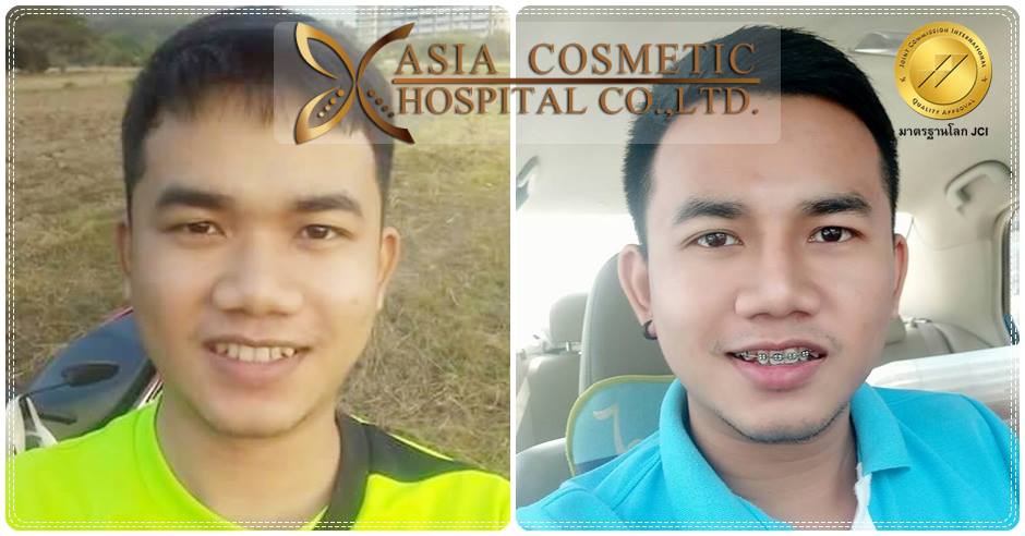 เสริมจมูกผู้ชาย