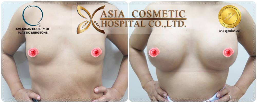 ศัลยกรรมหน้าอก