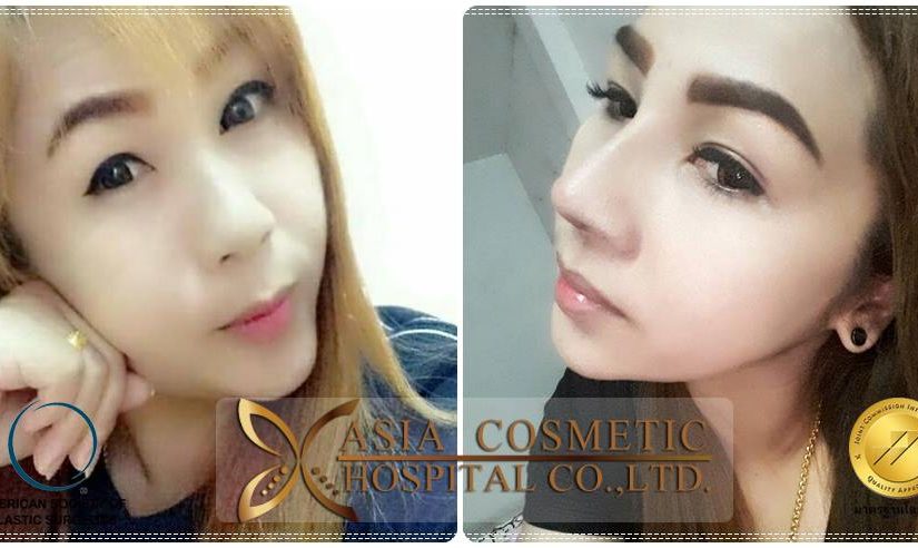 เสริมจมูกซิลิโคนอเมริกา