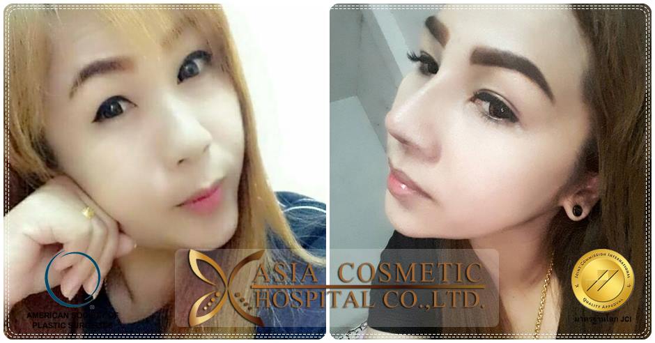 เสริมจมูกซิลิโคนอเมริกา