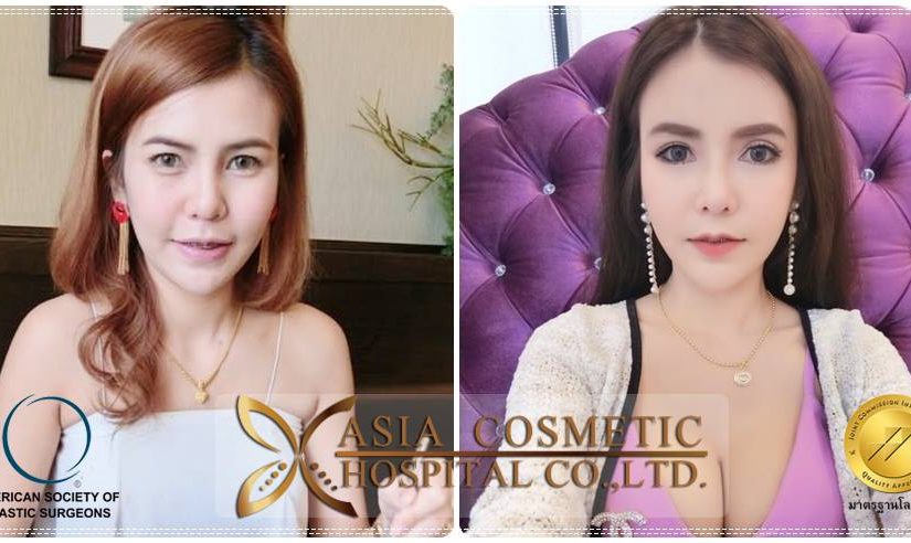 รีวิวยุบโหนกแก้ม