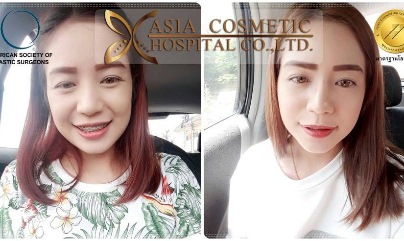 รีวิวจมูกสวยๆ