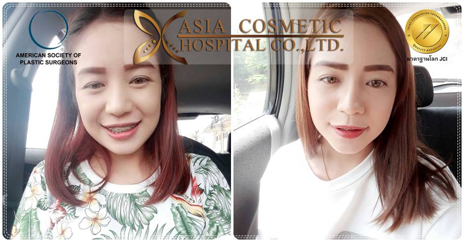 รีวิวจมูกสวยๆ