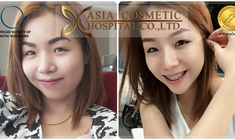 รีวิวเสริมจมูก