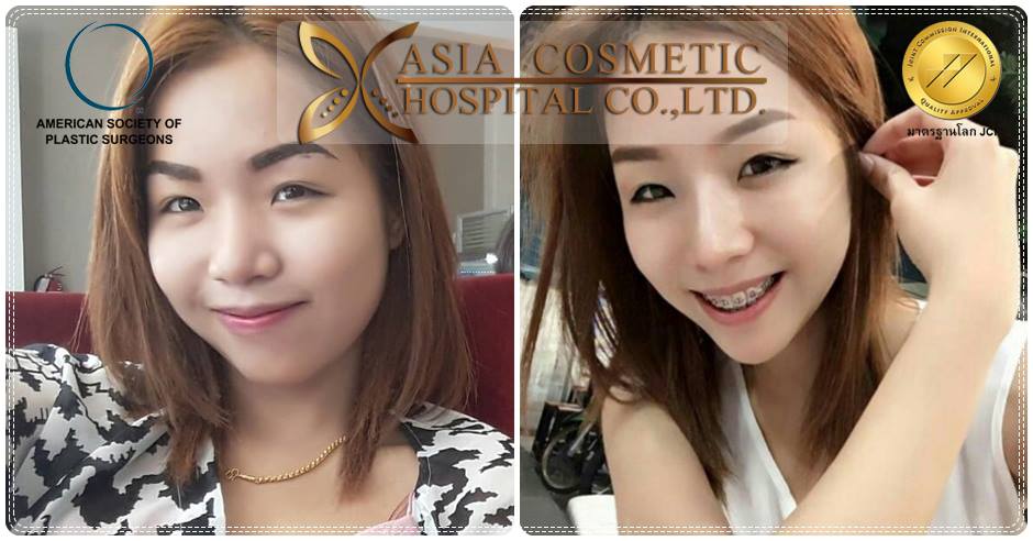 รีวิวเสริมจมูก