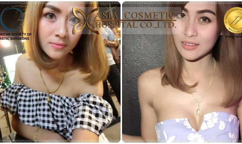 รีวิวเสริมหน้าอก