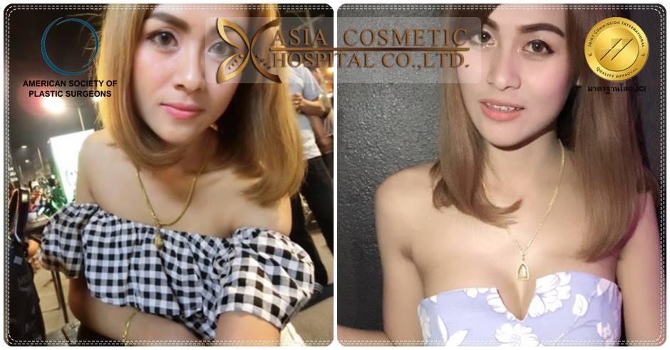 รีวิวเสริมหน้าอก