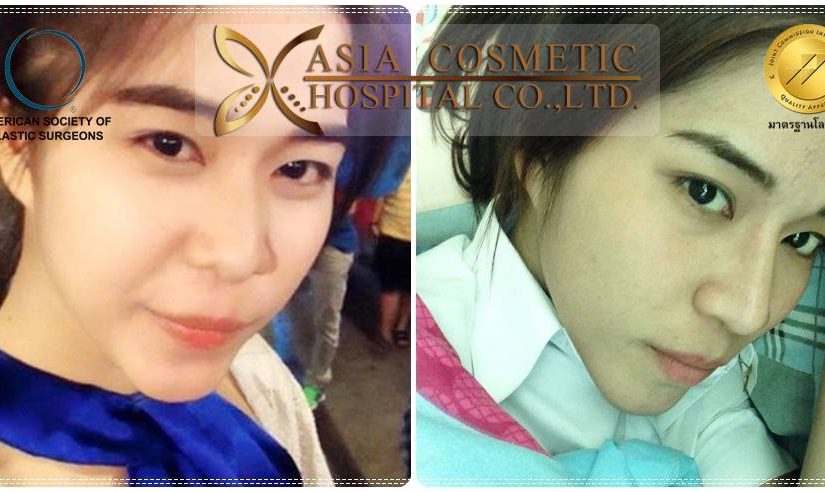 เสริมจมูกที่ไหนสวย