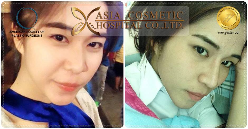 เสริมจมูกที่ไหนสวย