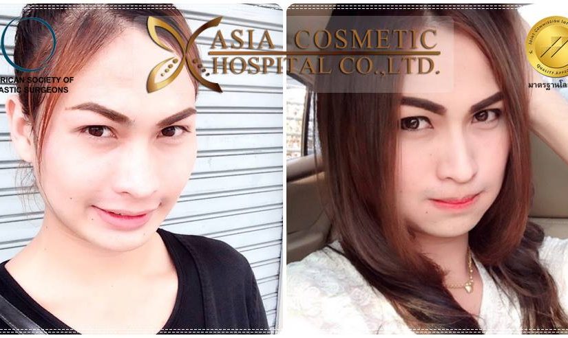 เสริมจมูกสวยๆ